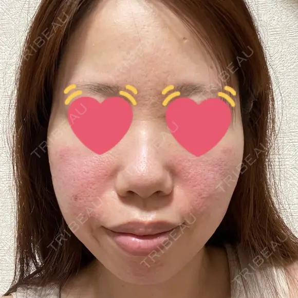 ボトックス（エラ・小顔） / ヒアルロン酸注入（鼻翼基部） 目白ホワイトクリニック DAY 1 メイン用