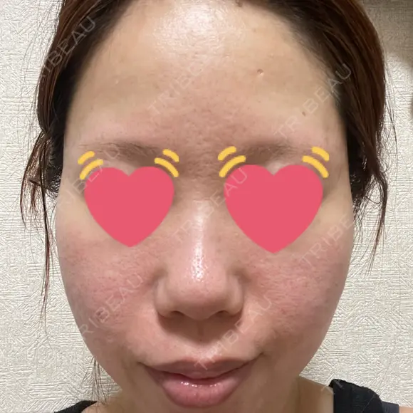 ボトックス（エラ・小顔） / ヒアルロン酸注入（鼻翼基部） 目白ホワイトクリニック AFTER メイン用