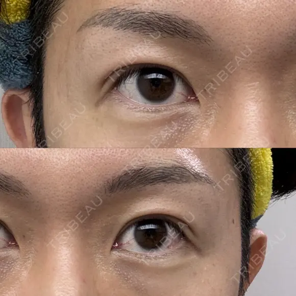 二重埋没 けやき美容クリニック 沼津院 AFTER メイン用