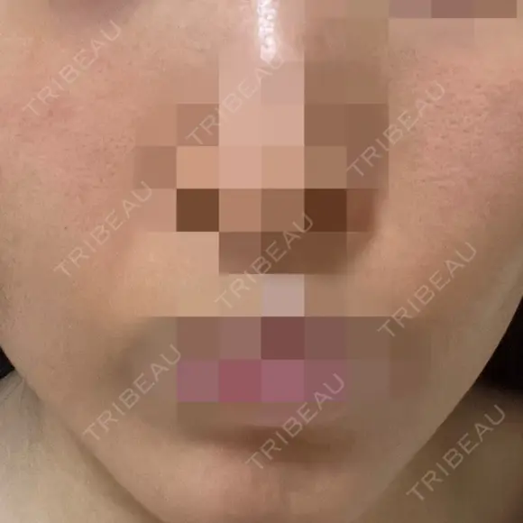 ニードルRF（ポテンツァなど） ながしま形成外科クリニック AFTER メイン用