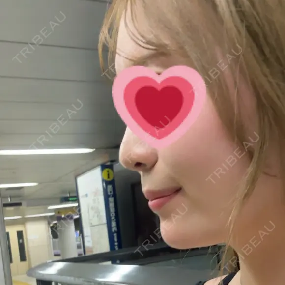 ヒアルロン酸注入（あご） 青山外苑前クリニック DAY 54 メイン用