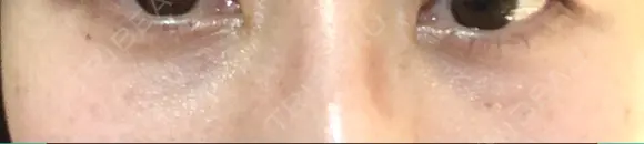 クマ治療 / 下まぶたたるみ取り 二子玉川美容外科クリニック AFTER メイン用