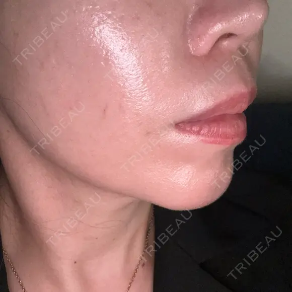 ボトックス（あご） / ボトックス（目尻） / ボトックス（額） 代々木駅前美容クリニック DAY 3 メイン用