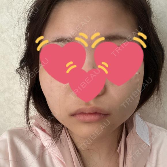 バッカルファット除去 / 脂肪吸引（顔） / メーラーファット除去 / ヒアルロン酸注入（あご） PRISM Beauty Clinic 町田院 DAY 1 メイン用