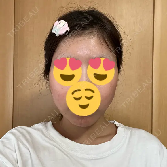 糸リフト / 脂肪吸引（顔） / ヒアルロン酸注入（あご） Wing clinic 豊中駅前院 DAY 2 メイン用