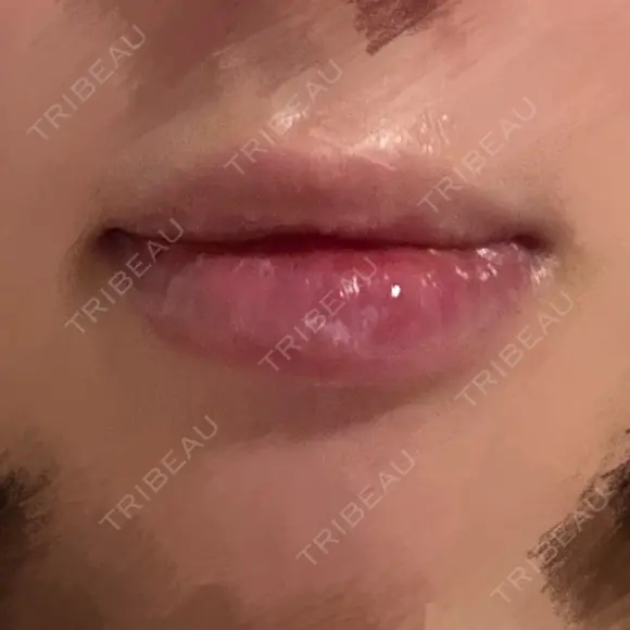 口唇縮小術 Kono Clinic AFTER メイン用