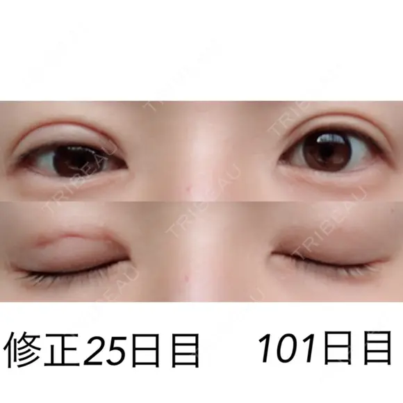 二重埋没 / 目元修正 湘南美容クリニック 広島院 DAY 25 メイン用