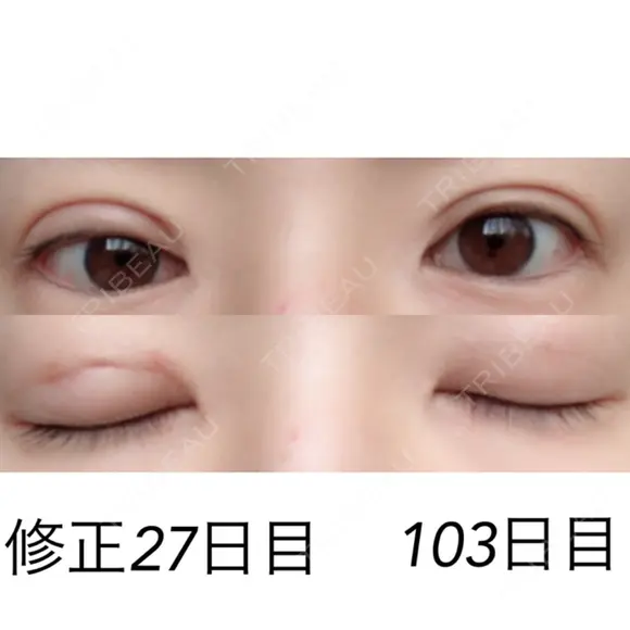 二重埋没 / 目元修正 湘南美容クリニック 広島院 DAY 27 メイン用