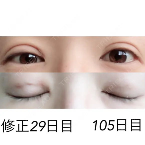 二重埋没 / 目元修正 湘南美容クリニック 広島院 DAY 29 メイン用