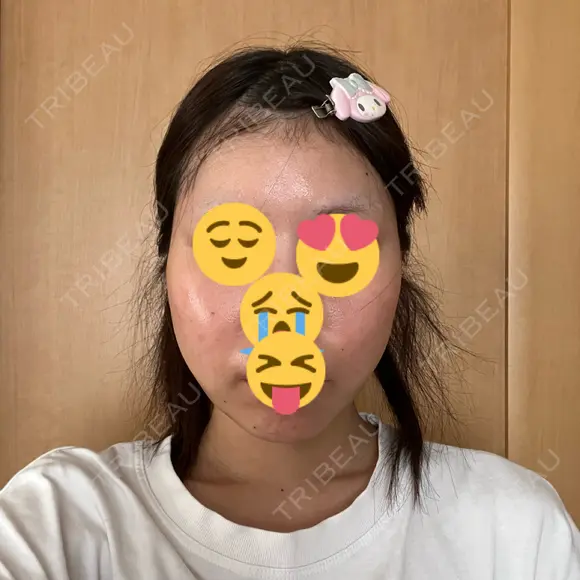 糸リフト / 脂肪吸引（顔） / ヒアルロン酸注入（あご） Wing clinic 豊中駅前院 DAY 3 メイン用