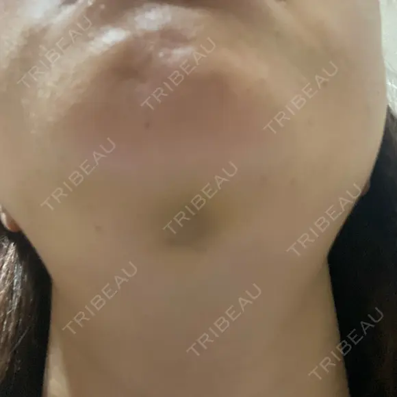 糸リフト / 脂肪吸引（顔） Wing clinic 豊中駅前院 AFTER メイン用