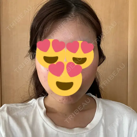 糸リフト / 脂肪吸引（顔） / ヒアルロン酸注入（あご） Wing clinic 豊中駅前院 DAY 4 メイン用