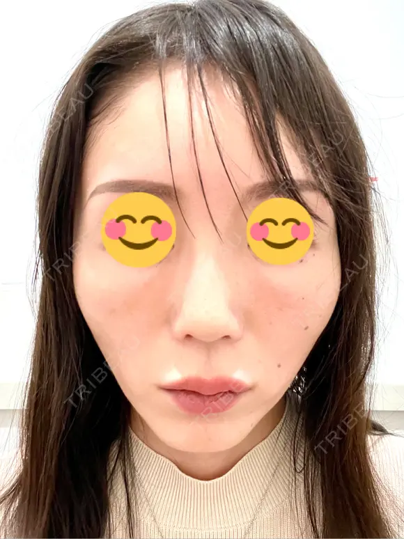 ヒアルロン酸注入（頬） 百人町アルファクリニック DAY 5 メイン用