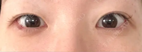 目尻切開 / タレ目形成・グラマラスライン（切開） / タレ目形成・グラマラスライン（埋没） A CLINIC（エークリニック） 大阪院 DAY 5 メイン用