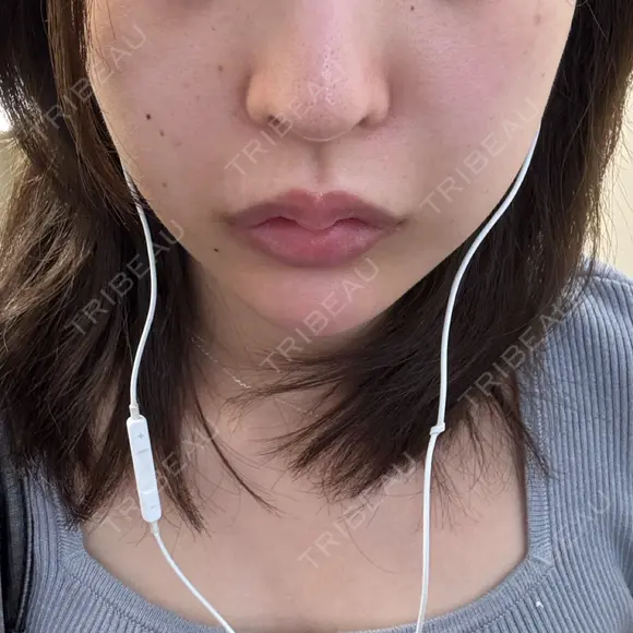 ヒアルロン酸注入（あご） DMTC CLINIC 日本橋院 DAY 0 メイン用