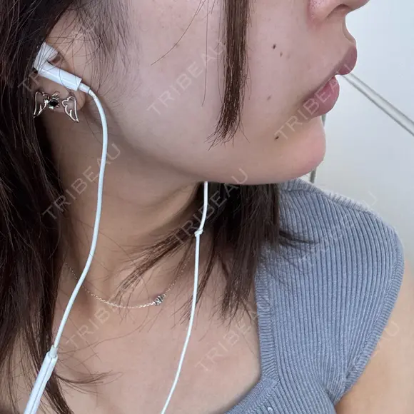 ヒアルロン酸注入（あご） DMTC CLINIC 日本橋院 DAY 0 メイン用