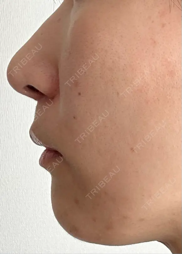 人中短縮 / 小鼻縮小（非切開） 湘南美容クリニック 仙台院 DAY 63 メイン用