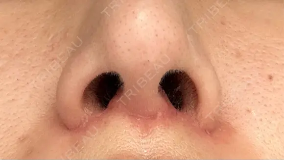 人中短縮 / 小鼻縮小（非切開） 湘南美容クリニック 仙台院 DAY 63 メイン用