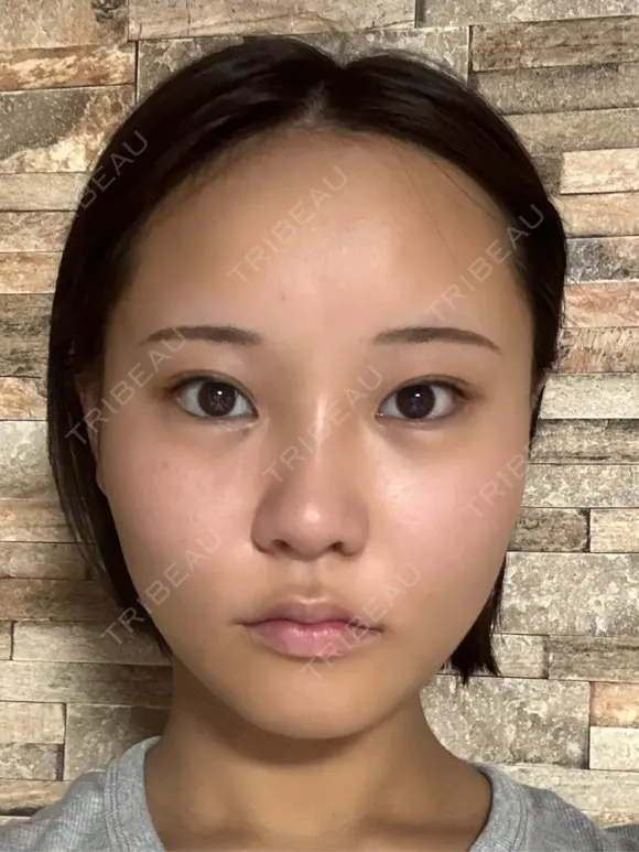 糸リフト / 脂肪吸引注射（顔） 札幌美容外科ネビュラクリニック AFTER メイン用