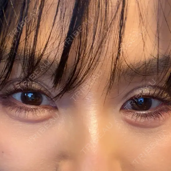 ヒアルロン酸注入（涙袋） / ボトックス（あご） ルラ美容クリニック 池袋院 DAY 1 メイン用