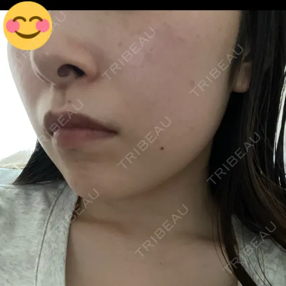 エレクトロポレーション / 光治療（フォトフェイシャルなど） / ピーリング（ハリ・ツヤ） トラスト美容クリニック 銀座院 DAY 0 メイン用
