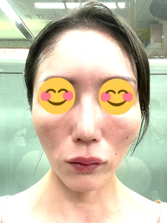 ヒアルロン酸注入（頬） 百人町アルファクリニック DAY 7 メイン用