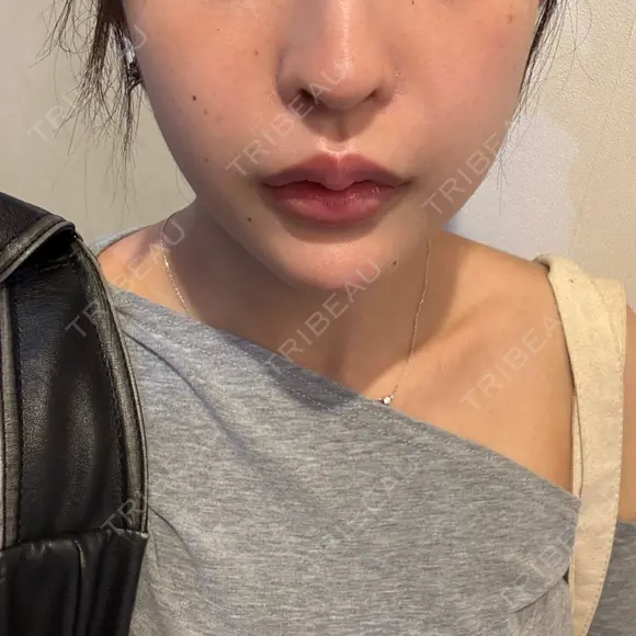 ヒアルロン酸注入（あご） DMTC CLINIC 日本橋院 AFTER メイン用
