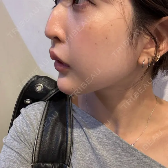 ヒアルロン酸注入（あご） DMTC CLINIC 日本橋院 DAY 1 メイン用