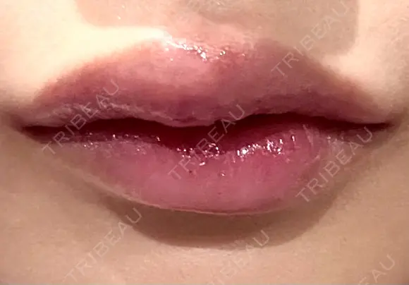 ヒアルロン酸注入（唇） 目白ホワイトクリニック DAY 0 メイン用