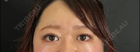 二重埋没 / 眼瞼下垂（切開） / 上まぶたの脂肪取り 藤・ナチュレ美容クリニック 銀座院 AFTER メイン用