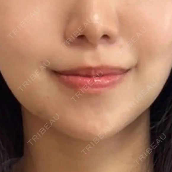 脂肪吸引（顔） ネビュラクリニック 京都院 DAY 2 メイン用