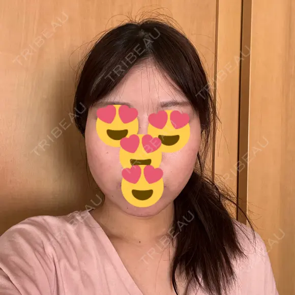 糸リフト / 脂肪吸引（顔） / ヒアルロン酸注入（あご） Wing clinic 豊中駅前院 DAY 7 メイン用