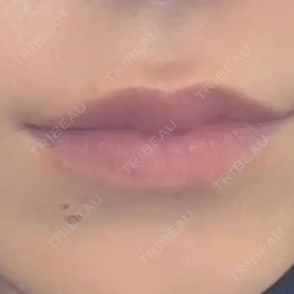 ボトックス（口角） mimi CLINIC DAY 1 メイン用