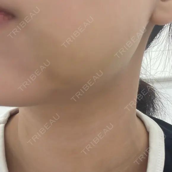 脂肪吸引（顔） ネビュラクリニック 京都院 DAY 3 メイン用