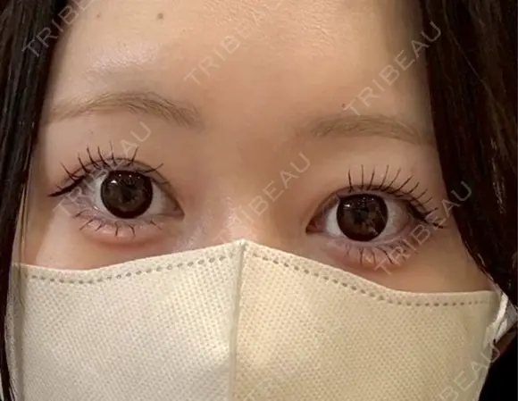 目頭切開 Brandnew Beauty Clinic DAY 293 メイン用