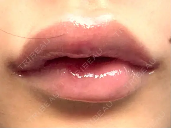 ヒアルロン酸注入（唇） 目白ホワイトクリニック DAY 1 メイン用