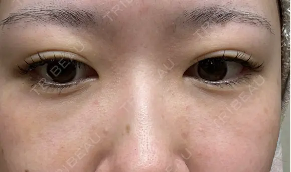 クマ治療 / 下まぶたたるみ取り / 下まぶたの脂肪取り APOLLO BEAUTY CLINIC DAY 12 メイン用