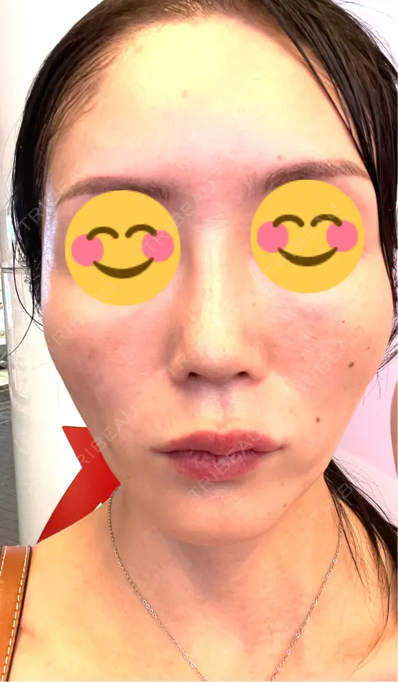 ヒアルロン酸注入（頬） 百人町アルファクリニック DAY 8 メイン用