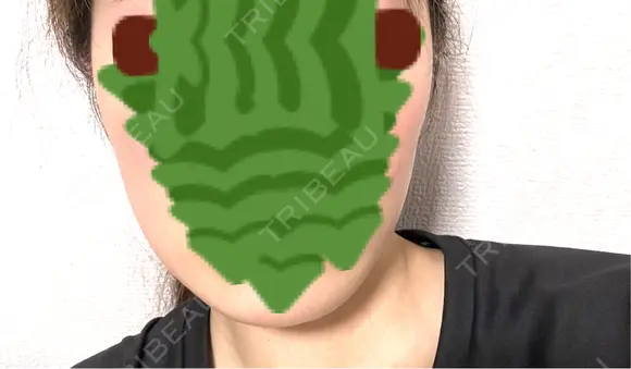 ハイフ（顔） 表参道メディカルクリニック 名古屋院 AFTER メイン用