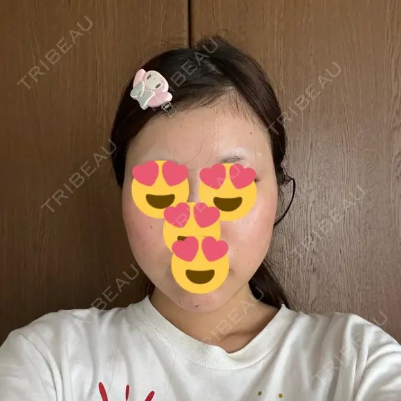 糸リフト / 脂肪吸引（顔） / ヒアルロン酸注入（あご） Wing clinic 豊中駅前院 DAY 8 メイン用