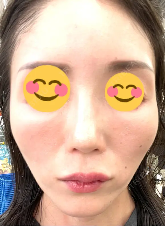 ヒアルロン酸注入（頬） 百人町アルファクリニック DAY 9 メイン用