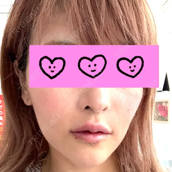 ヒアルロン酸注入（唇） 目白ホワイトクリニック DAY 0 メイン用