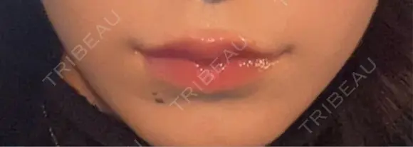 ボトックス（口角） mimi CLINIC DAY 2 メイン用