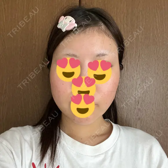 糸リフト / 脂肪吸引（顔） / ヒアルロン酸注入（あご） Wing clinic 豊中駅前院 AFTER メイン用