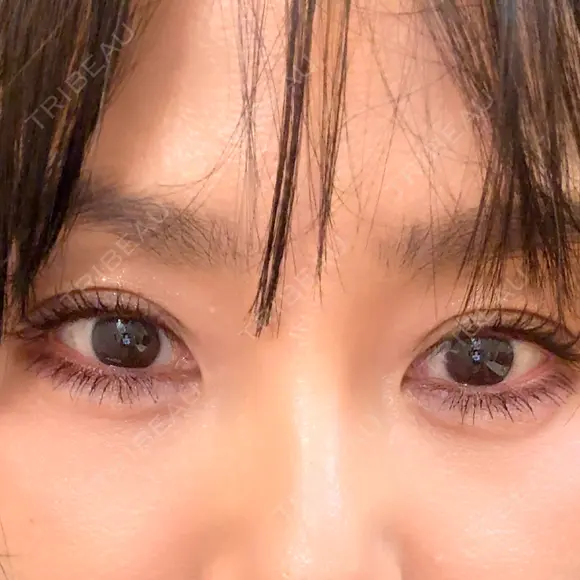 ヒアルロン酸注入（涙袋） / ボトックス（あご） ルラ美容クリニック 池袋院 DAY 4 メイン用