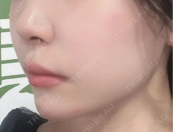 ヒアルロン酸注入（涙袋） / 肌ヒアルロン酸注入（たるみ・シワ改善） / ヒアルロン酸注入（唇） / ボトックス（口角） 東京シルククリニック 新宿院 AFTER メイン用