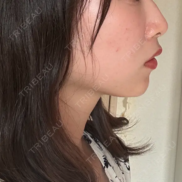 ボトックス（あご） / ヒアルロン酸注入（あご） TCB東京中央美容外科 梅田茶屋町院 DAY 0 メイン用