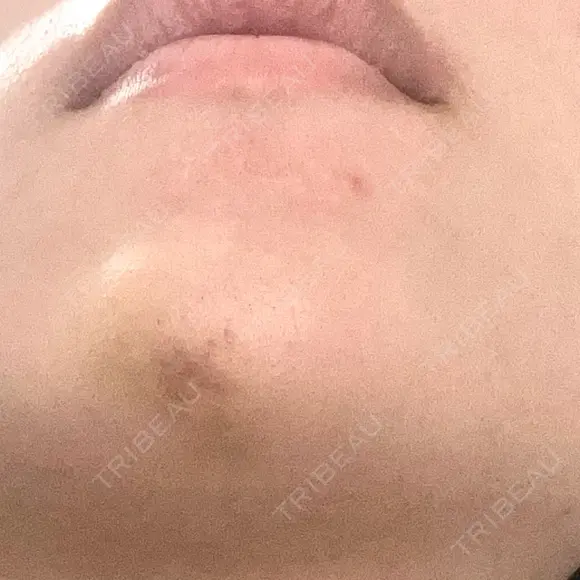 ボトックス（あご） / ヒアルロン酸注入（あご） TCB東京中央美容外科 梅田茶屋町院 DAY 6 メイン用