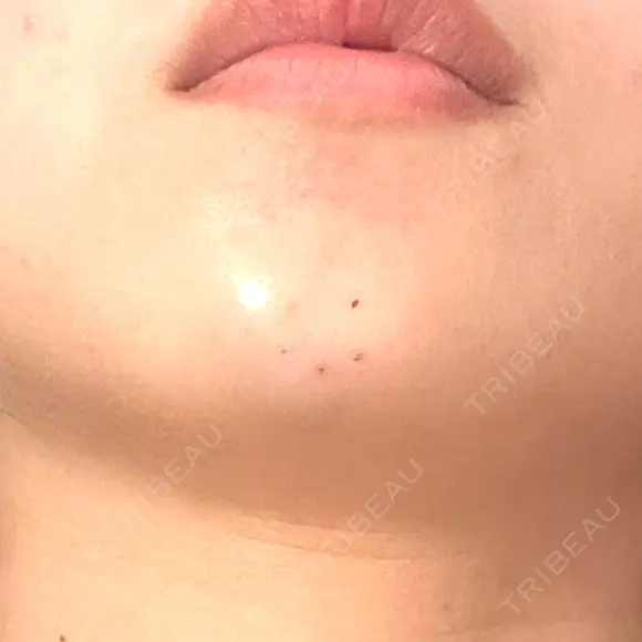 ボトックス（あご） / ヒアルロン酸注入（あご） TCB東京中央美容外科 梅田茶屋町院 DAY 0 メイン用