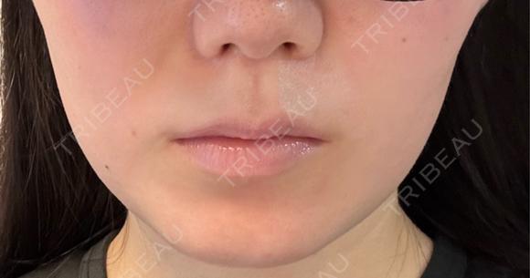 ボトックス（エラ・小顔） / RF（高周波）たるみ治療 PureMe Skin Clinic（ピュアミースキンクリニック麻布） AFTER メイン用